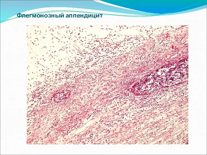 Флегмонозный аппендицит