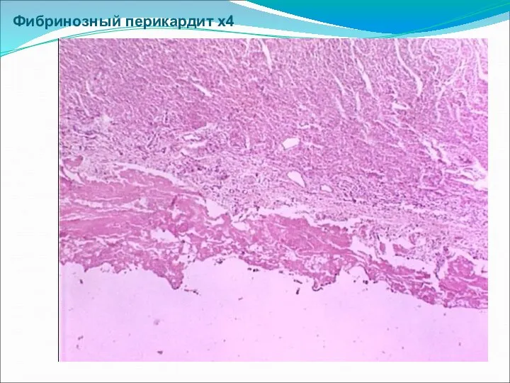 Фибринозный перикардит х4