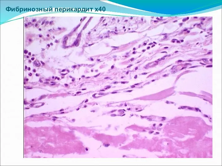 Фибринозный перикардит х40