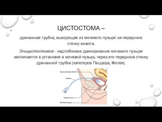 ЦИСТОСТОМА – дренажная трубка, выходящая из мочевого пузыря на переднюю стенку