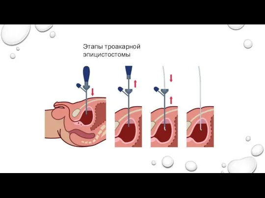 Этапы троакарной эпицистостомы