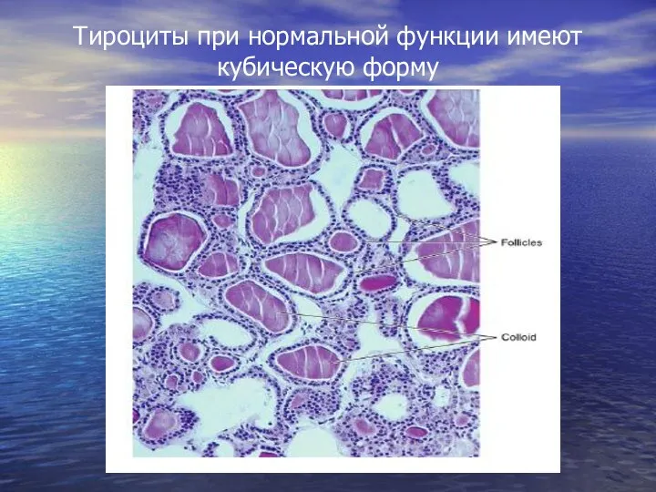 Тироциты при нормальной функции имеют кубическую форму