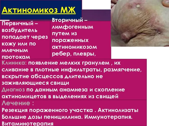 Актиномикоз МЖ Первичный – возбудитель попадает через кожу или по млечным