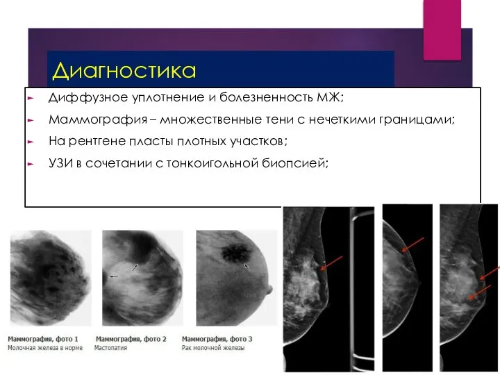 Диагностика Диффузное уплотнение и болезненность МЖ; Маммография – множественные тени с