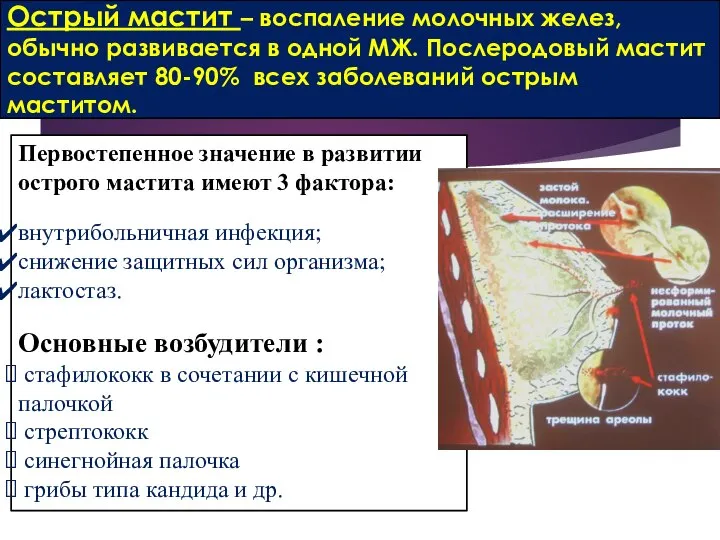 Острый мастит – воспаление молочных желез, обычно развивается в одной МЖ.