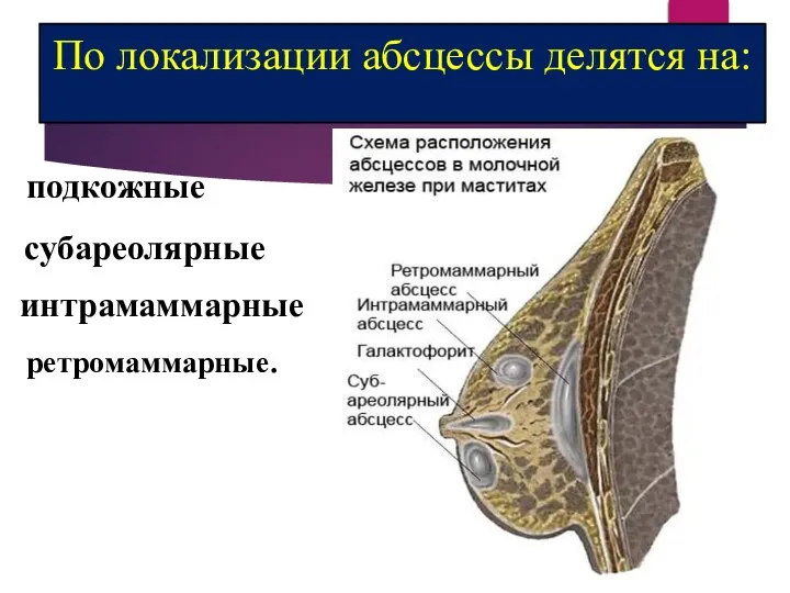 По локализации абсцессы делятся на: подкожные субареолярные интрамаммарные ретромаммарные.