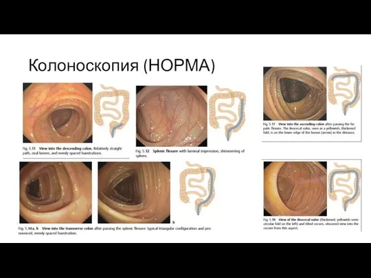 Колоноскопия (НОРМА)