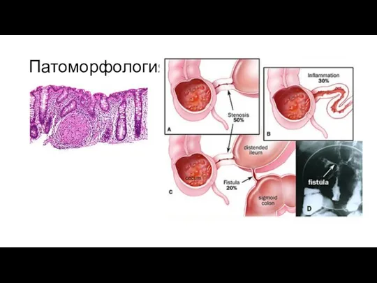 Патоморфология