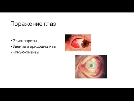 Поражение глаз Эписклериты Увеиты и иридоциклиты Конъюктивиты