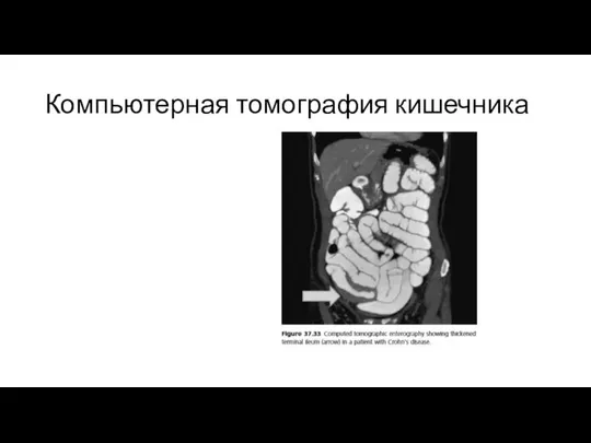 Компьютерная томография кишечника