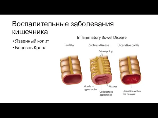 Воспалительные заболевания кишечника Язвенный колит Болезнь Крона