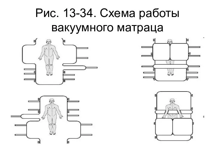 Рис. 13-34. Схема работы вакуумного матраца