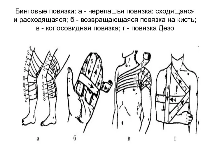 Бинтовые повязки: а - черепашья повязка: сходящаяся и расходящаяся; б -