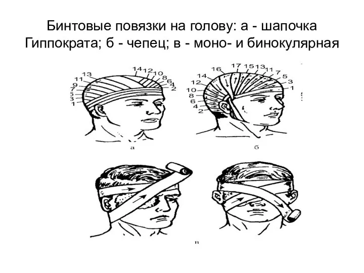 Бинтовые повязки на голову: а - шапочка Гиппократа; б - чепец; в - моно- и бинокулярная