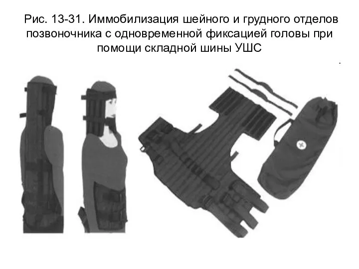 Рис. 13-31. Иммобилизация шейного и грудного отделов позвоночника с одновременной фиксацией