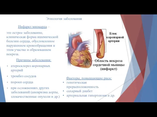 Этиология заболевания Инфаркт миокарда – это острое заболевание, клиническая форма ишемической