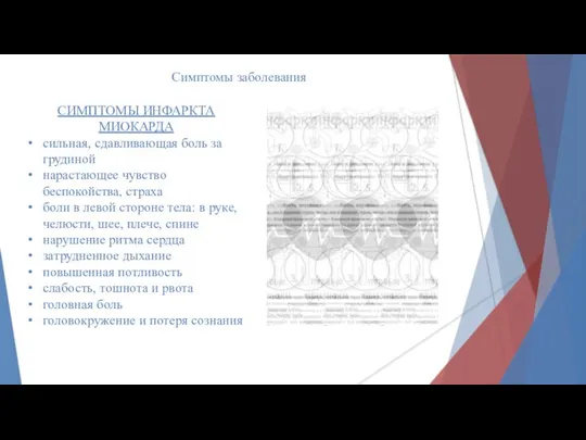 Симптомы заболевания СИМПТОМЫ ИНФАРКТА МИОКАРДА сильная, сдавливающая боль за грудиной нарастающее