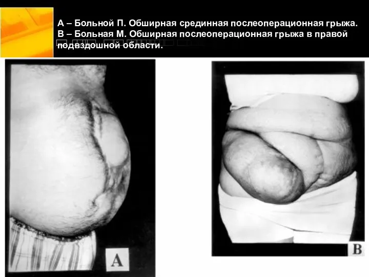 А – Больной П. Обширная срединная послеоперационная грыжа. В – Больная