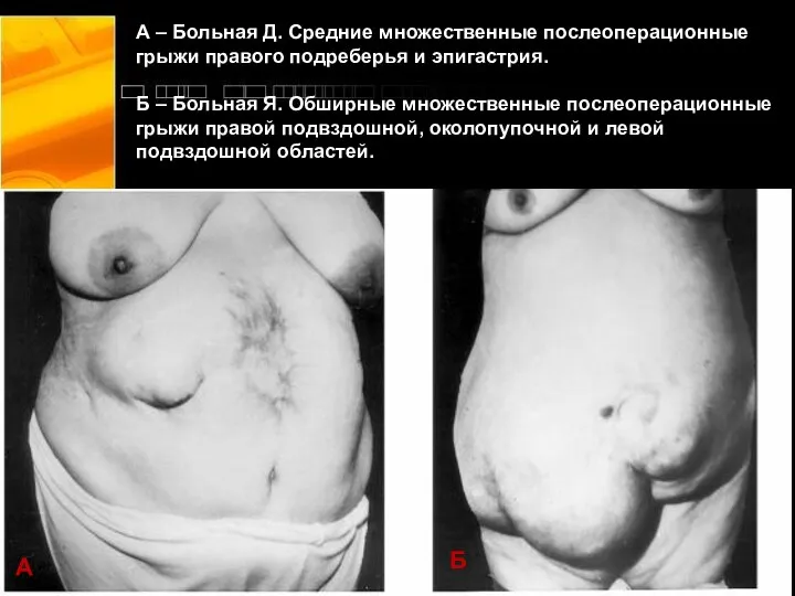 А – Больная Д. Средние множественные послеоперационные грыжи правого подреберья и