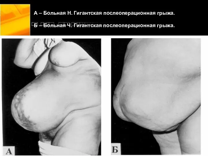 А – Больная Н. Гигантская послеоперационная грыжа. Б – Больная Ч. Гигантская послеоперационная грыжа.