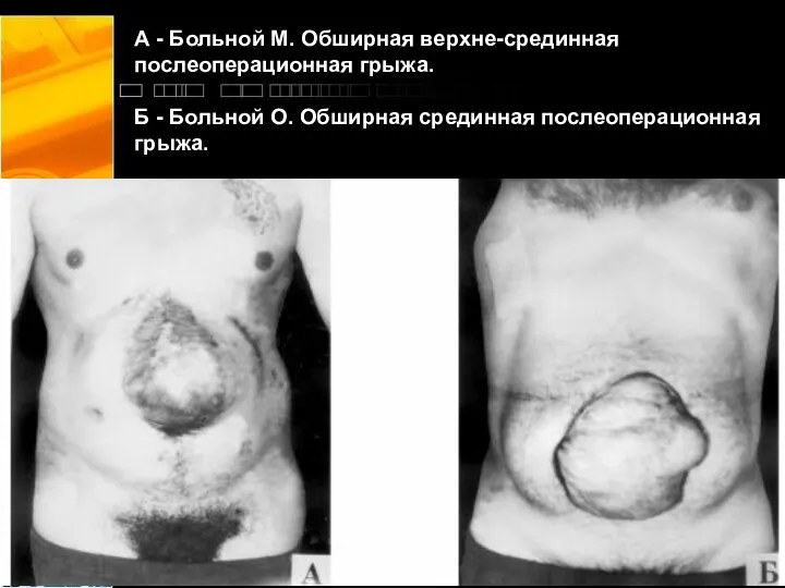 А - Больной М. Обширная верхне-срединная послеоперационная грыжа. Б - Больной О. Обширная срединная послеоперационная грыжа.