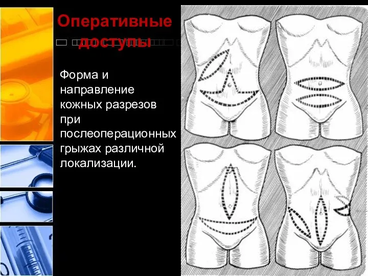 Оперативные доступы Форма и направление кожных разрезов при послеоперационных грыжах различной локализации.