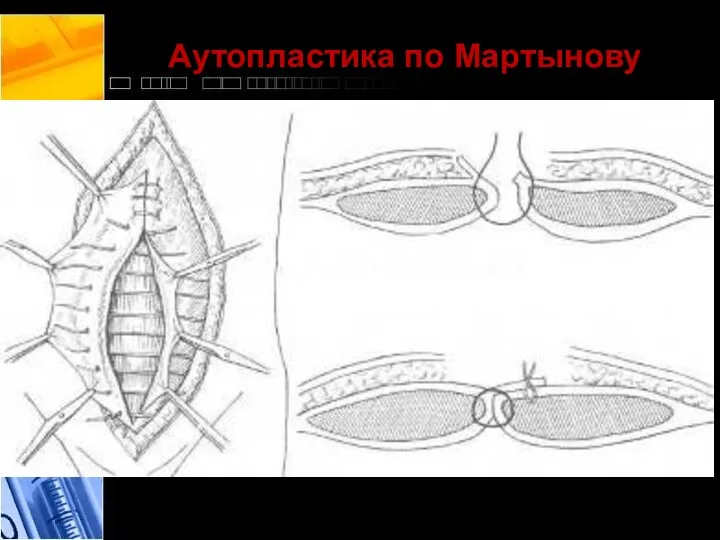 Аутопластика по Мартынову