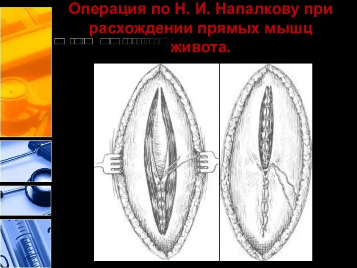 Операция по Н. И. Напалкову при расхождении прямых мышц живота.