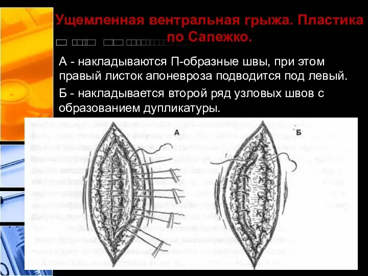 Ущемленная вентральная грыжа. Пластика по Сапежко. А - накладываются П-образные швы,