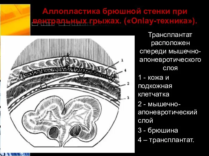 Аллопластика брюшной стенки при вентральных грыжах. («Onlay-техника»). Трансплантат расположен спереди мышечно-апоневротического