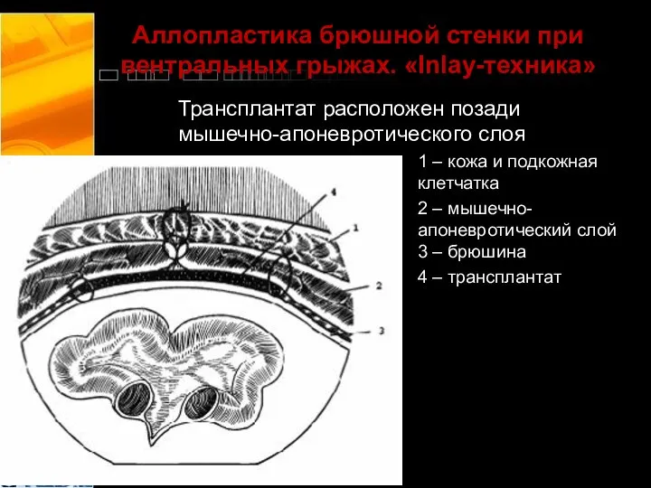 Аллопластика брюшной стенки при вентральных грыжах. «Inlay-техника» Трансплантат расположен позади мышечно-апоневротического