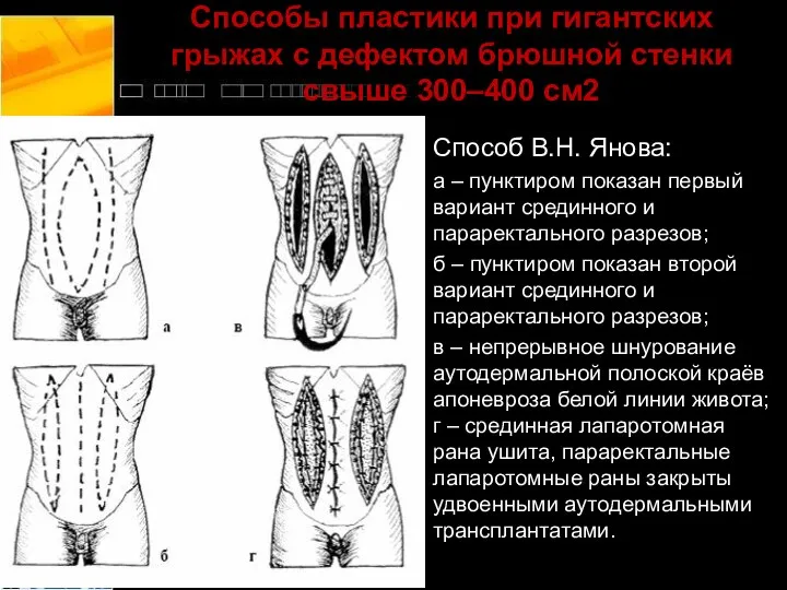 Способы пластики при гигантских грыжах с дефектом брюшной стенки свыше 300–400