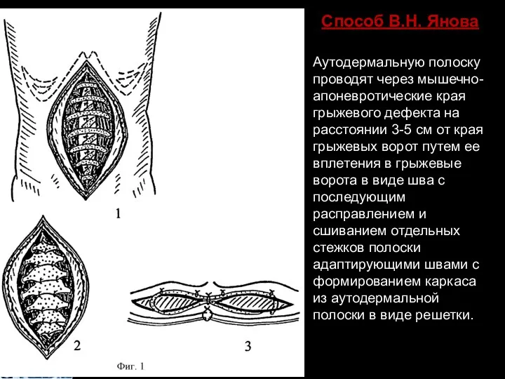 Способ В.Н. Янова Аутодермальную полоску проводят через мышечно-апоневротические края грыжевого дефекта