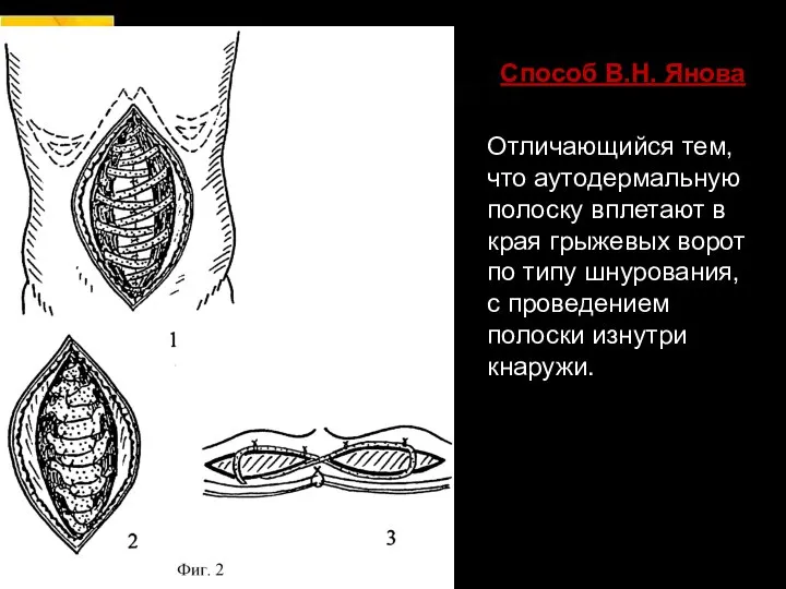 Способ В.Н. Янова Отличающийся тем, что аутодермальную полоску вплетают в края