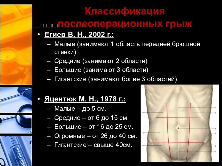 Классификация послеоперационных грыж Егиев В. Н., 2002 г.: Малые (занимают 1