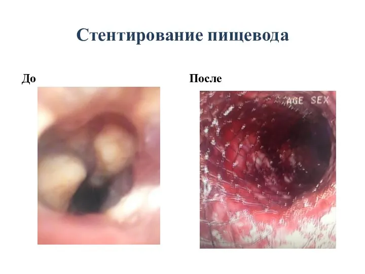 Стентирование пищевода До После