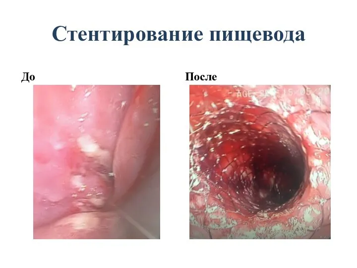 Стентирование пищевода До После