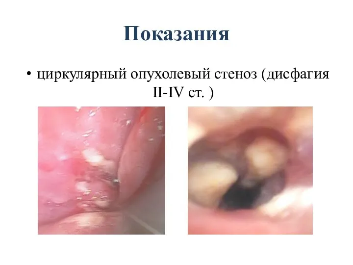 Показания циркулярный опухолевый стеноз (дисфагия II-IV ст. )