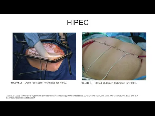 HIPEC Esquivel, J. (2009). Technology of Hyperthermic Intraperitoneal Chemotherapy in the