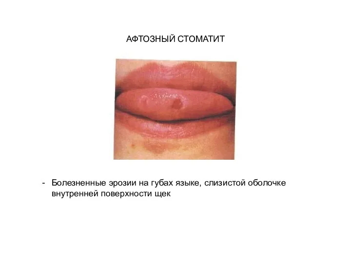 АФТОЗНЫЙ СТОМАТИТ Болезненные эрозии на губах языке, слизистой оболочке внутренней поверхности щек