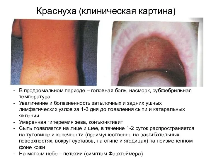 В продромальном периоде – головная боль, насморк, субфебрильная температура Увеличение и