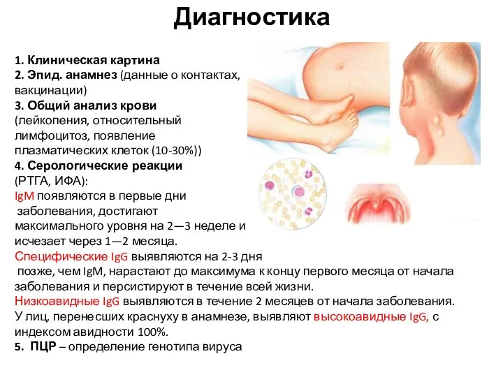 Диагностика 1. Клиническая картина 2. Эпид. анамнез (данные о контактах, вакцинации)