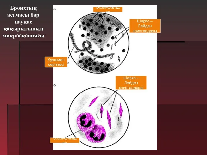 Эозинфильдер Шарко –Лейден кристалдары Куршман серппесі Шарко –Лейден кристалдары Эозинфильдер Бронхтық астмасы бар науқас қақырығының микроскопиясы