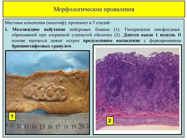 Морфологические проявления Местные изменения (илеотиф), протекает в 5 стадий: 1. Мозговидное