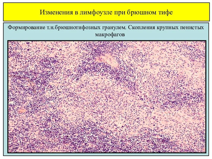 Изменения в лимфоузле при брюшном тифе Формирование т.н.брюшнотифозных гранулем. Скопления крупных пенистых макрофагов