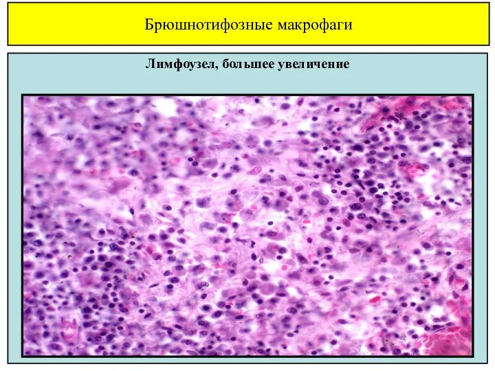 Брюшнотифозные макрофаги Лимфоузел, большее увеличение