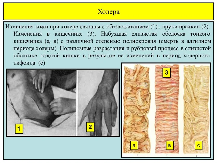 Холера Изменения кожи при холере связаны с обезвоживанием (1)., «руки прачки»