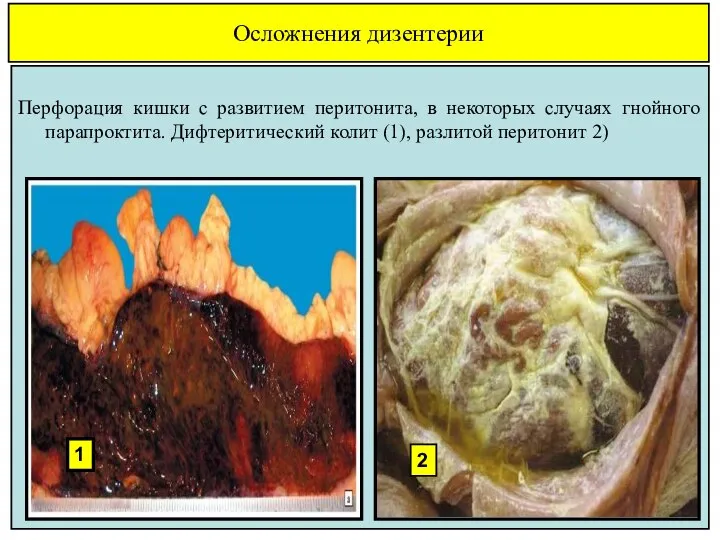 Осложнения дизентерии Перфорация кишки с развитием перитонита, в некоторых случаях гнойного
