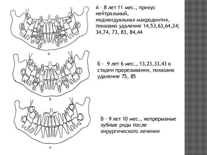 А – 8 лет 11 мес., прикус нейтральный, индивидуальная макродонтия, показано