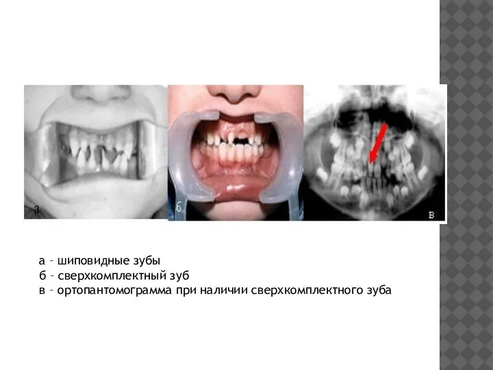 а – шиповидные зубы б – сверхкомплектный зуб в – ортопантомограмма при наличии сверхкомплектного зуба